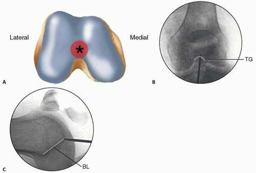 Retrograde Intramedullary Nailing of the Femur | Musculoskeletal Key