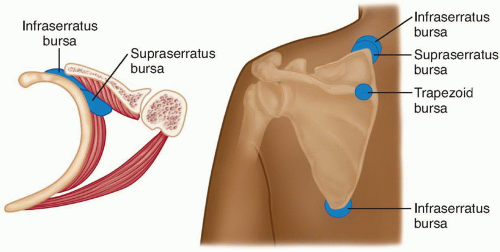 Bursita tratamentului subclavicular al articulației umărului