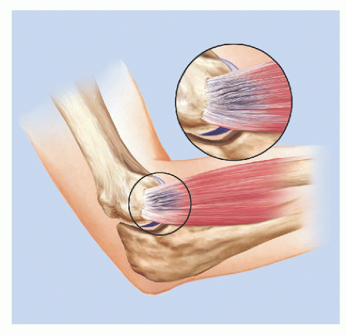 Lateral Epicondylitis | Musculoskeletal Key