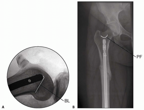 Retrograde Intramedullary Nailing Of The Femur | Musculoskeletal Key