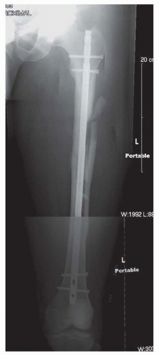 Antegrade Intramedullary Nailing Of The Femur | Musculoskeletal Key