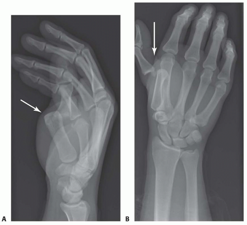 What Happens In The Volar Subluxation Of The Metacarpal Joint ZYQTNC What Happens In The Volar Subluxation Of The Metacarpal Joint ZYQTNC