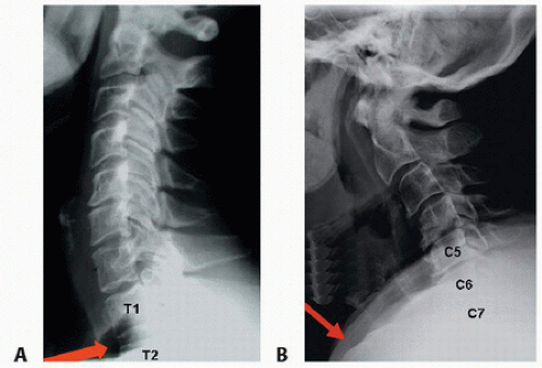Anterior Cervical Approaches | Musculoskeletal Key