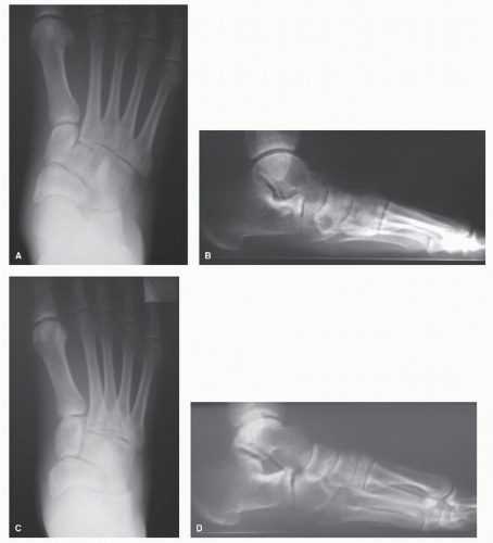 Arthroereisis | Musculoskeletal Key