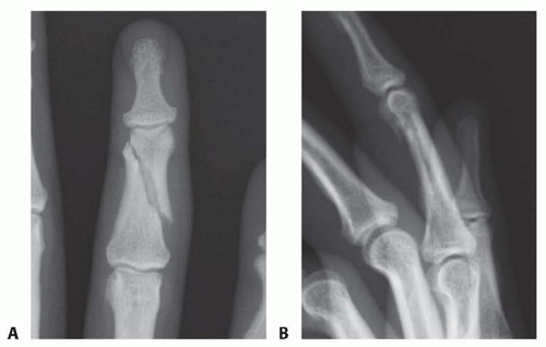 Operative Treatment of Extra-articular Phalangeal Fractures ...