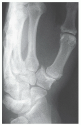 Osteoarthritis At The Base Of The Thumb Carpometacarpal Joint Musculoskeletal Key 2806