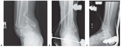 External Fixation Of The Tibia Musculoskeletal Key