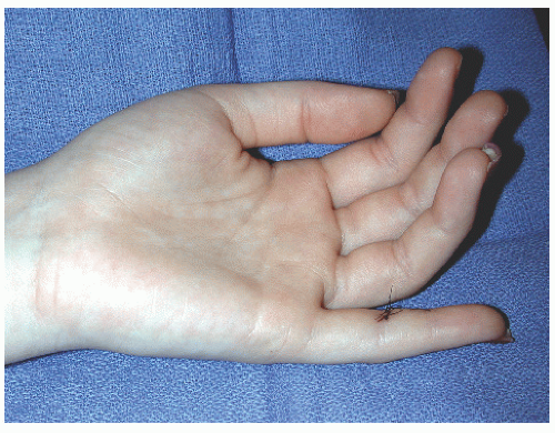 How To Treat Soft Tissue Damage In Finger