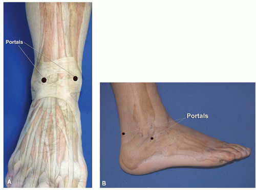 Arthroscopy Of The Ankle And Foot Musculoskeletal Key