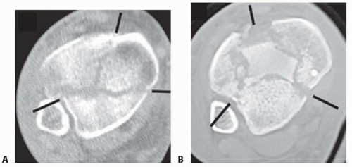 Open Reduction And Internal Fixation Of The Pilon | Musculoskeletal Key