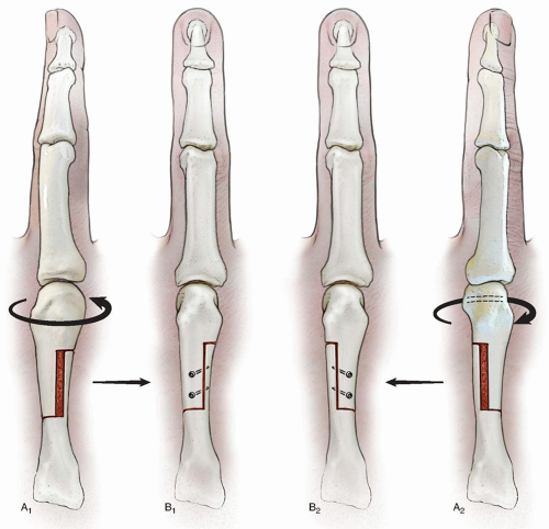 Corrective Osteotomy For Metacarpal And Phalangeal Malunion ...