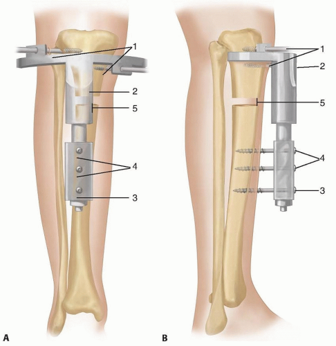 Syme And Boyd Amputations For Fibular Deficiency | Musculoskeletal Key