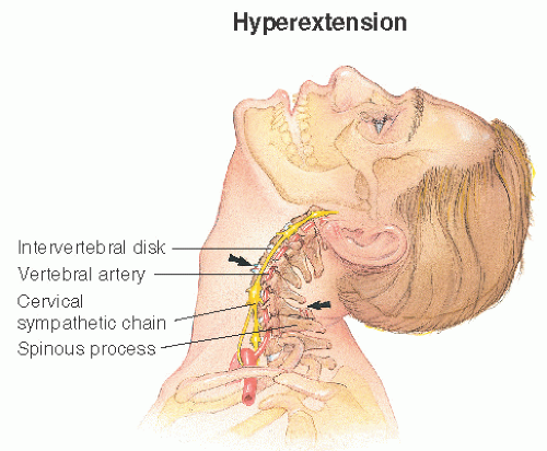 hyperextension neck