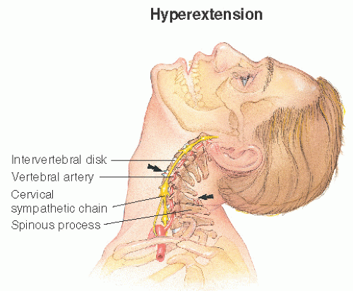 Cervical Strain Whiplash Musculoskeletal Key