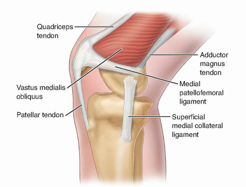 medial patellar facet