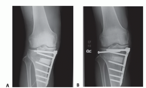 Upper Tibial Osteotomy (High Tibial Osteotomy) | Musculoskeletal Key