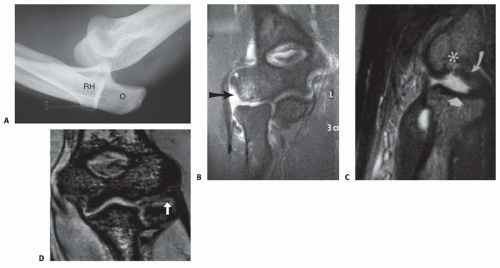 Lateral Collateral Ligament Reconstruction of the Elbow ...