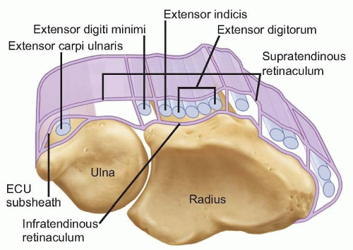 Extensor Carpi Ulnaris Subluxation