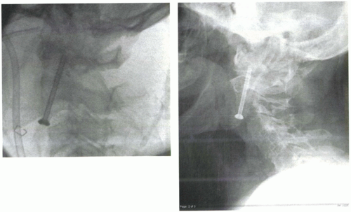 posterior screw fixation odontoid fracture