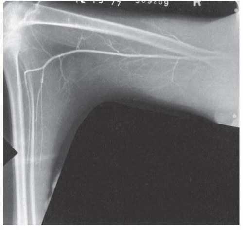 Limb-Length Discrepancy | Musculoskeletal Key