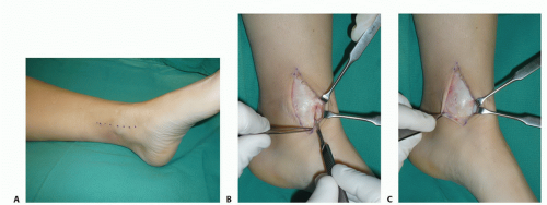 Osteochondral Transfer For Osteochondral Lesions Of The Talus