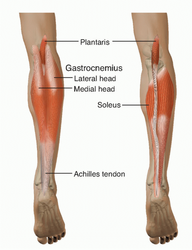 Open Achilles Tendon Repair | Musculoskeletal Key