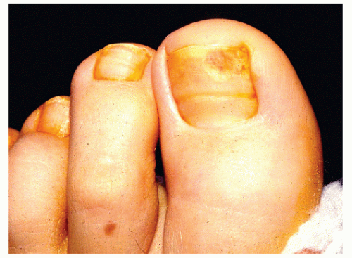 Figure 1 from Nail matrix phenolization for treatment of ingrowing nail:  technique report and recurrence rate of 267 surgeries. | Semantic Scholar