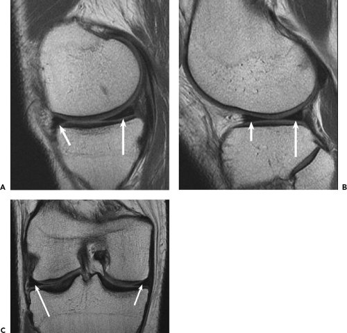 Imaging of the Knee | Musculoskeletal Key