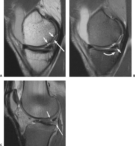 Imaging of the Knee | Musculoskeletal Key