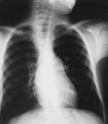 Fetal Pulmonary Stenosis