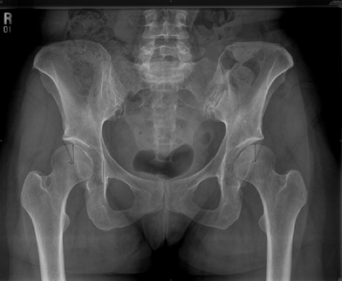 Lower Extremity Considerations: Hip | Musculoskeletal Key