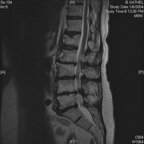 Osteoarthritis Of The Spine