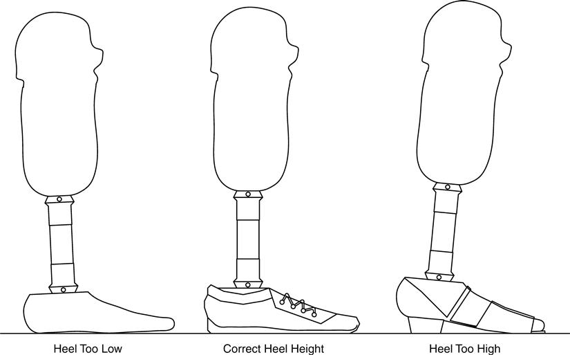 Transtibial Prosthetics | Musculoskeletal Key