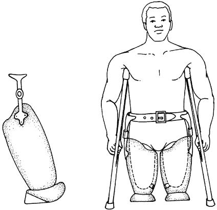 Prosthetic Options For Persons With High-Level And Bilateral Lower-Limb ...