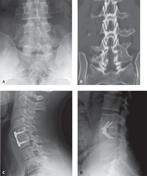 Spinal Imaging For Pseudarthrosis Musculoskeletal Key