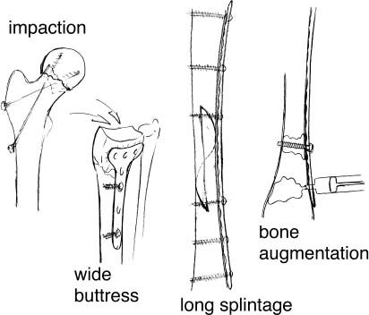 Basic Principles And Techniques Of Internal Fixation In Osteoporotic ...