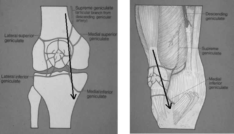The Medial Parapatellar Approach to the Knee | Musculoskeletal Key