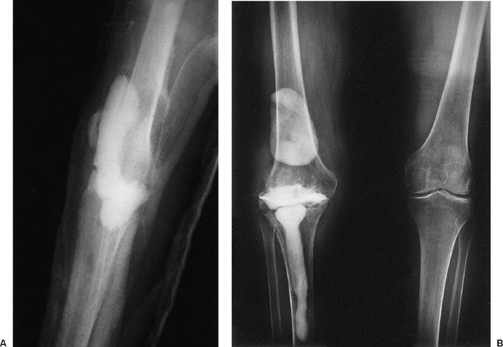 Infected Total Knee Replacement: Cement Spacer | Musculoskeletal Key