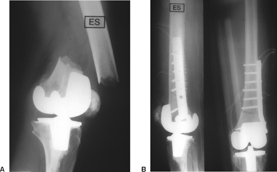 Fracture Above Total Knee Arthroplasty: Femur | Musculoskeletal Key