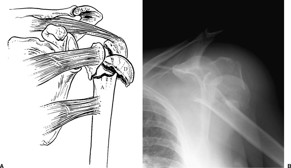 Four-Part Fractures and Fracture-Dislocations | Musculoskeletal Key
