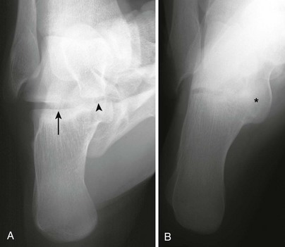 Application of medial column classification in treatment of intra-articular  calcaneal fractures