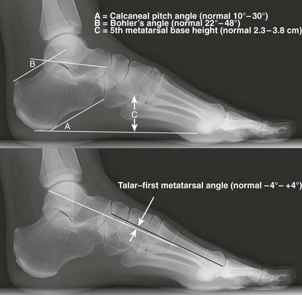 sustentaculum tali lateral x ray heel