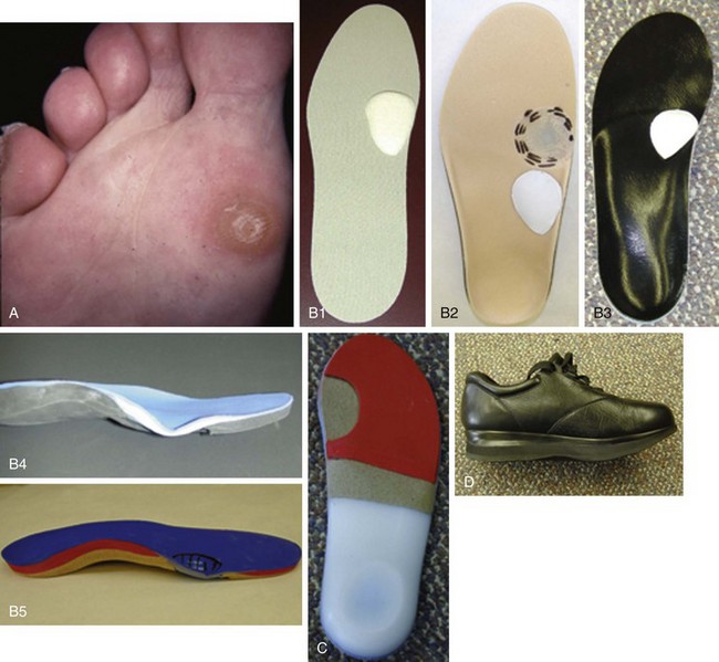 Accessory Bones of the Foot 