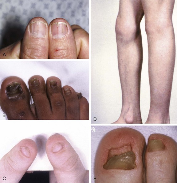 PDF) An Atlas of Nail Disorders, Part 6