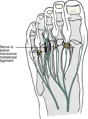 nerve plantar nerves medial metatarsal ligament disorders transverse branch courses third note under figure illustration musculoskeletalkey