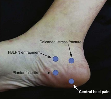 heel fracture pain
