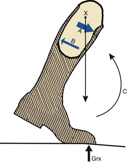 Lower Limb Prosthetics | Musculoskeletal Key