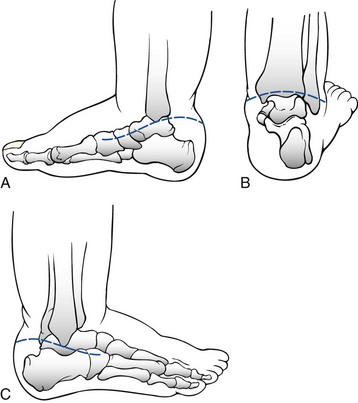 Congenital Foot Deformities | Musculoskeletal Key