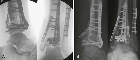 Pilon Fractures | Musculoskeletal Key