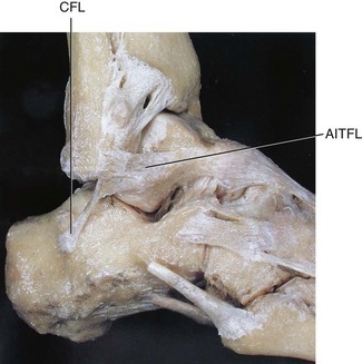 Ankle Fractures | Musculoskeletal Key